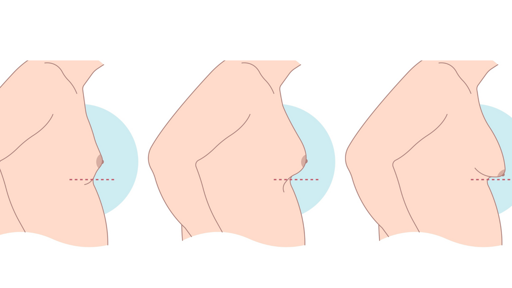 Does Gynecomastia Go Away?